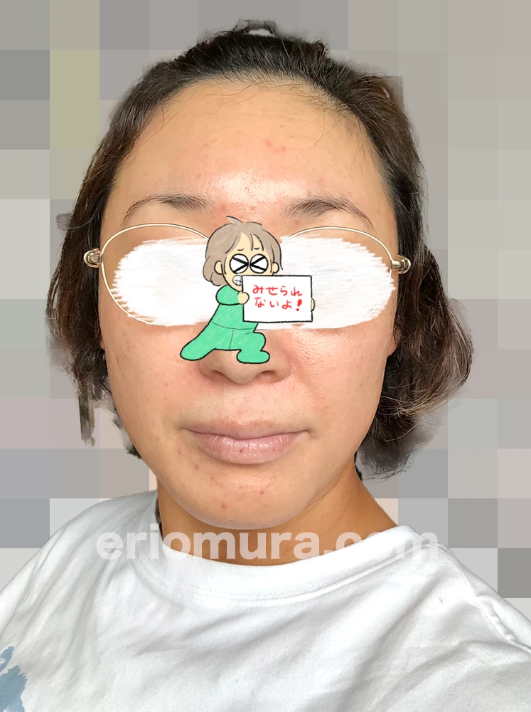 光フェイシャルを受けてみた。