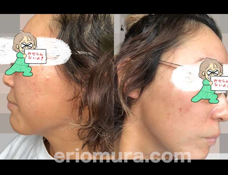 光フェイシャルを受けてみた。