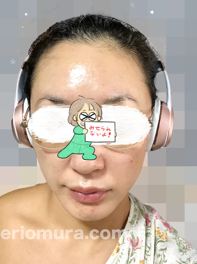 光フェイシャルを受けてみた。