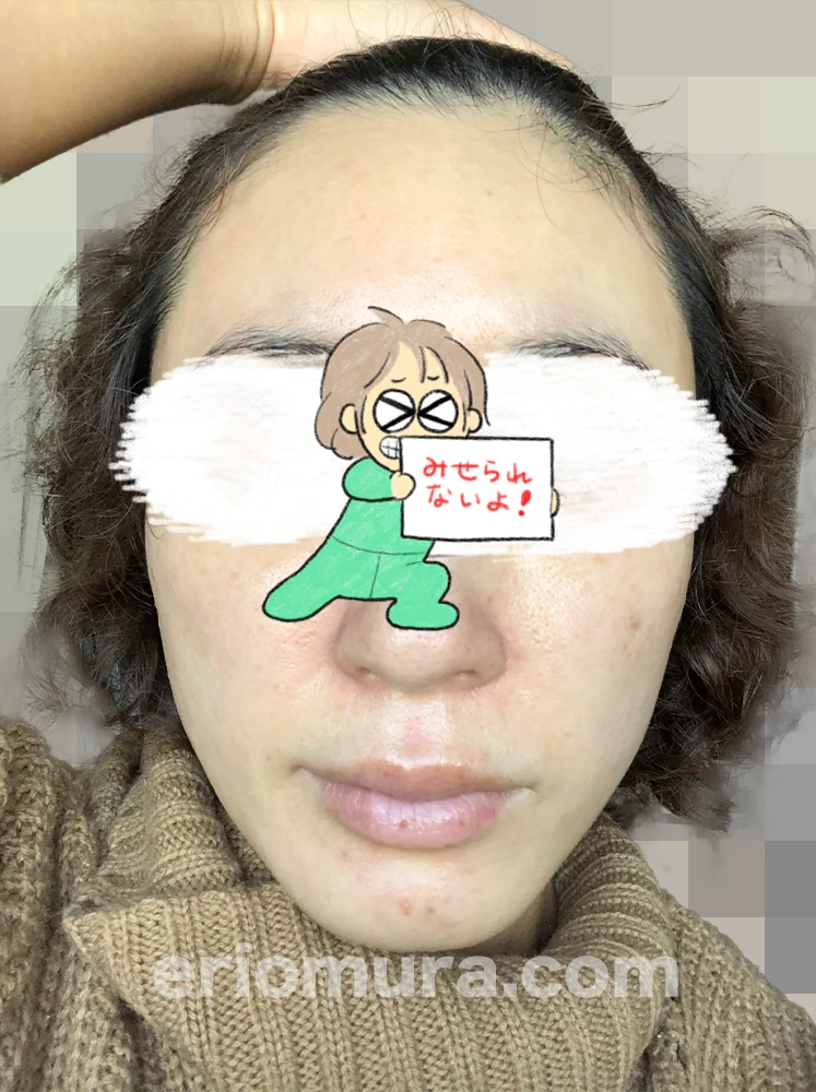 光フェイシャルを受けてみた。